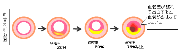 血管の断面の説明図